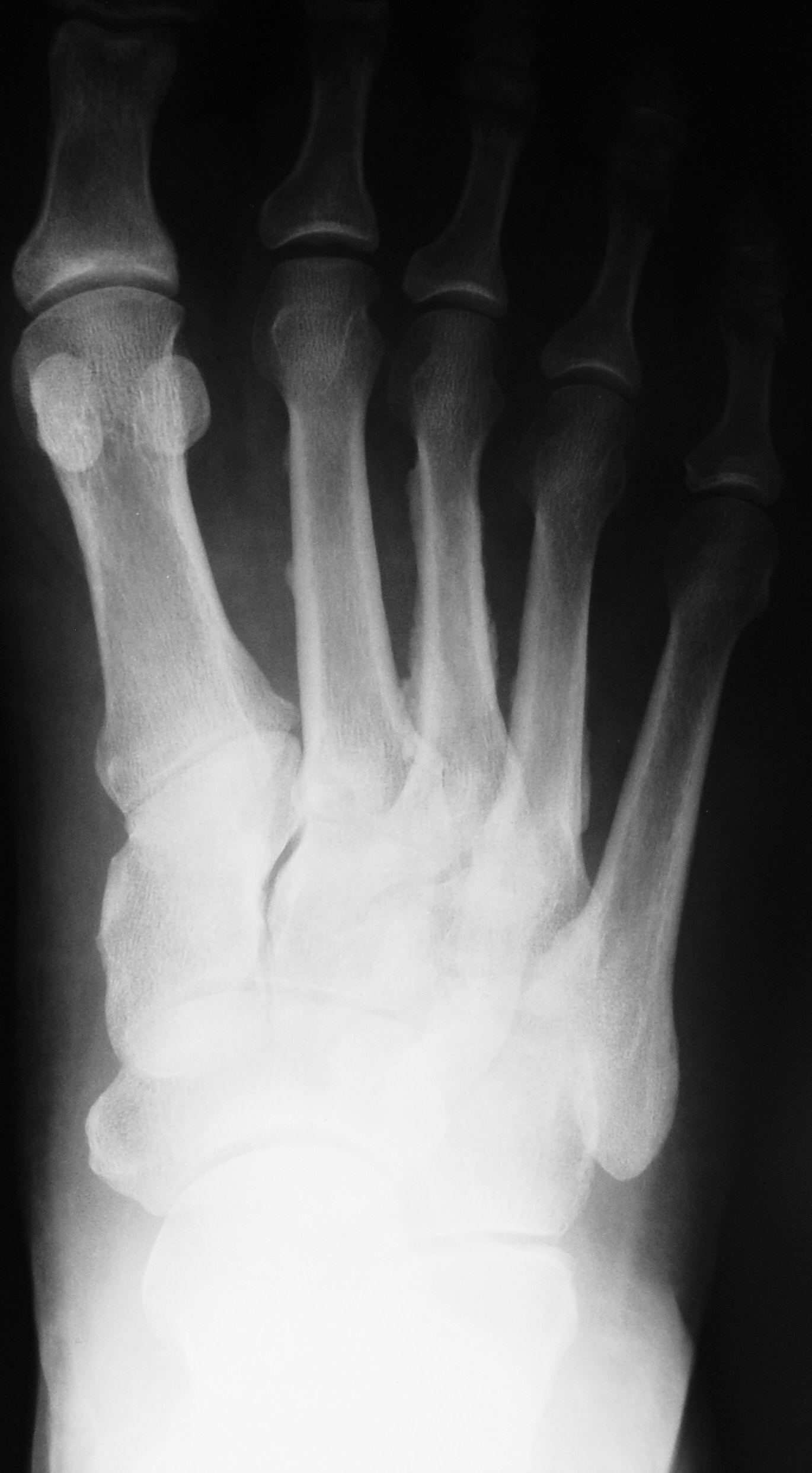 Маршевый перелом плюсневой кости рентген